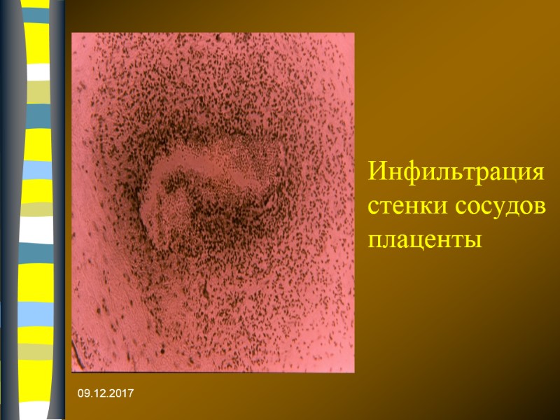 09.12.2017 Инфильтрация стенки сосудов плаценты